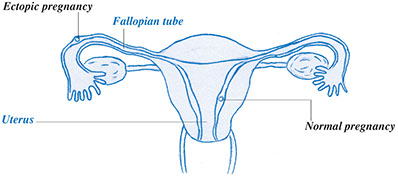 Illustration of normal vs ectopic pregnancy.