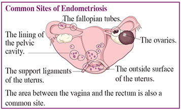 Common sites of endometriosis. Common sites of endometriosis.