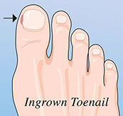 Illustration of ingrown toenail.