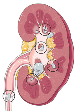 Illustration of kidney stones.