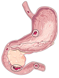 Signs and symptoms of peptic ulcers. Illustration of a peptic ulcer.