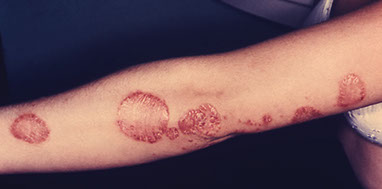 Image of psoriasis.