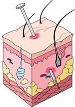 Illustration of a puncture.