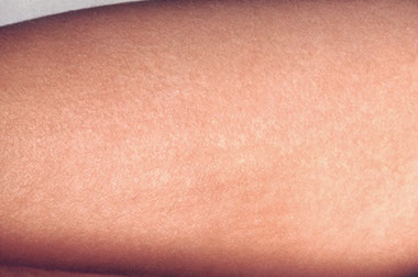 Image of scarlet fever.
