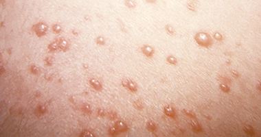 Image of the shingles.