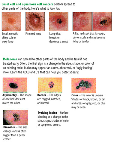 Chart showing the different types of skin cancers.
