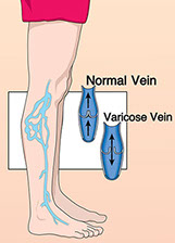 Signs and symptoms of varicose veins. Illustration of varicose veins.